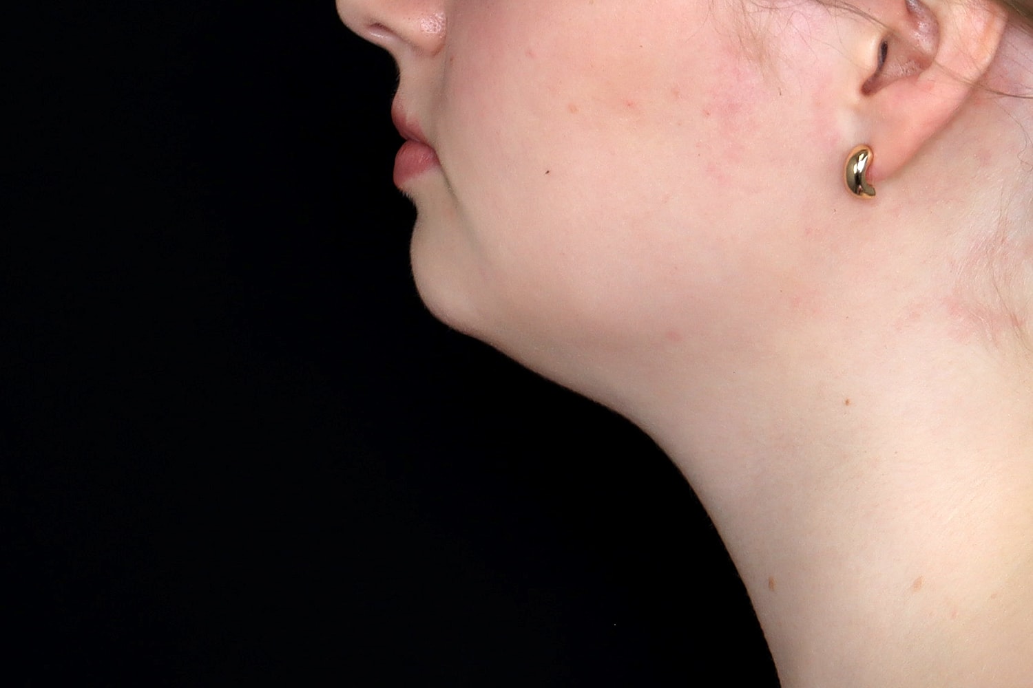 Chin Liposuction Before & After