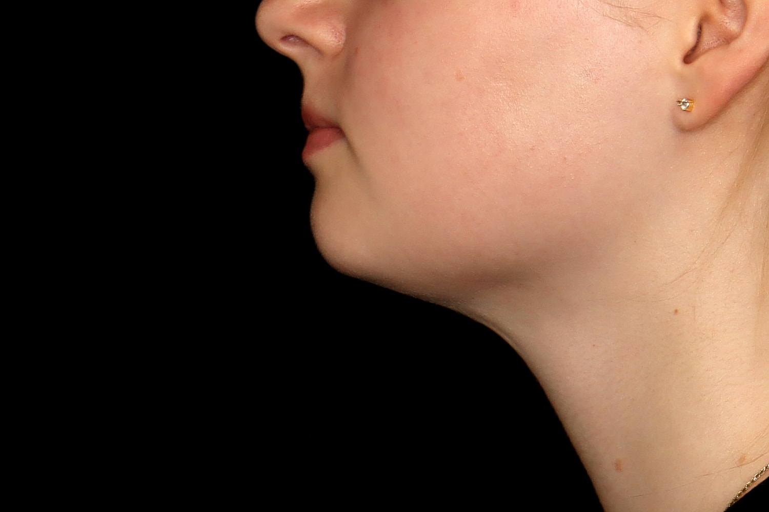 Chin Liposuction Before & After