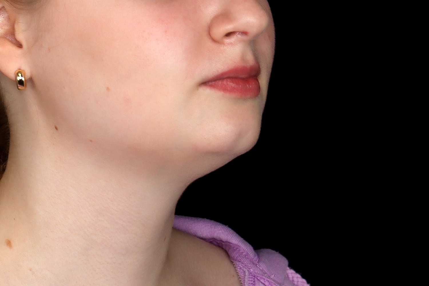 Chin Liposuction Before & After