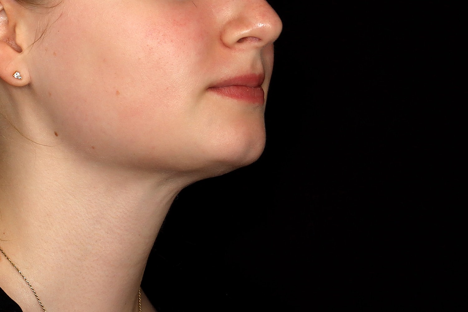 Chin Liposuction Before & After
