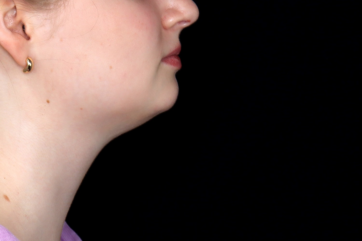 Chin Liposuction Before & After