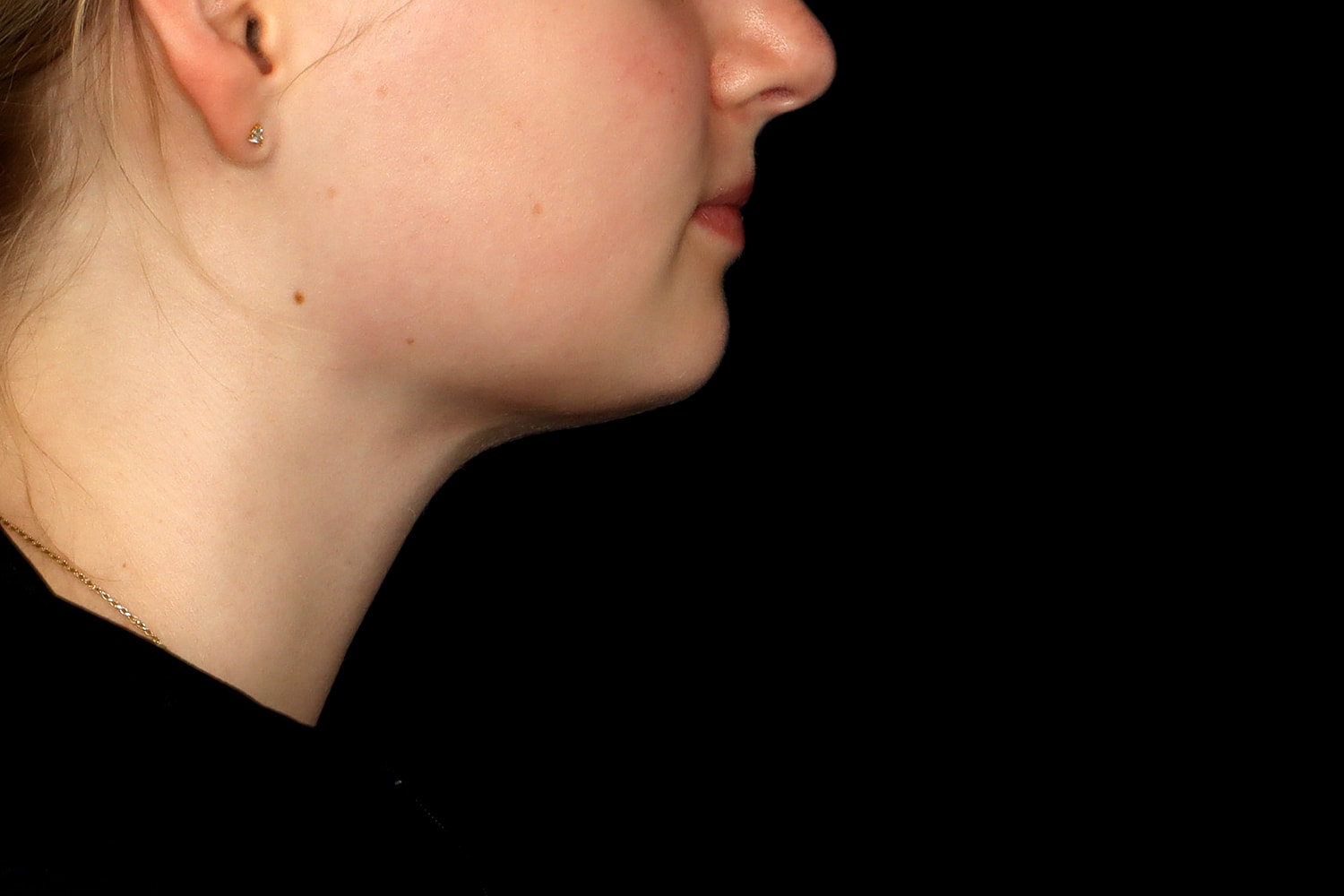 Chin Liposuction Before & After