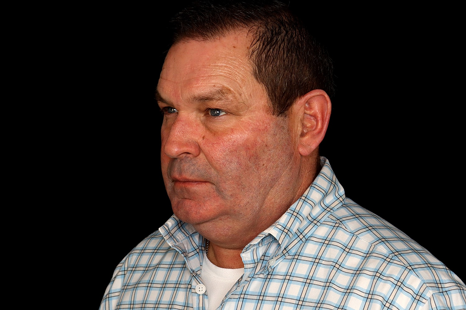 Chin Liposuction Before & After