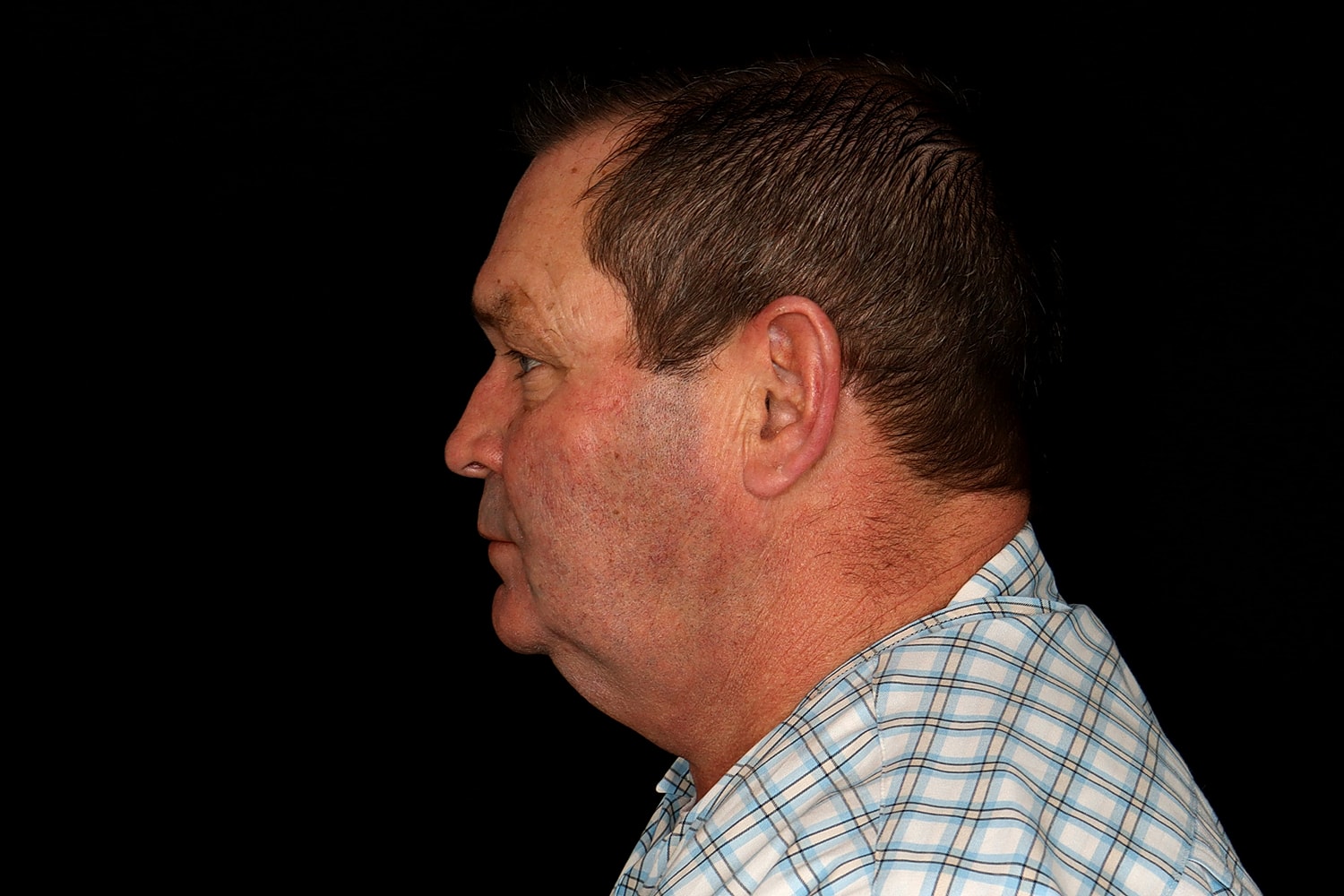 Chin Liposuction Before & After