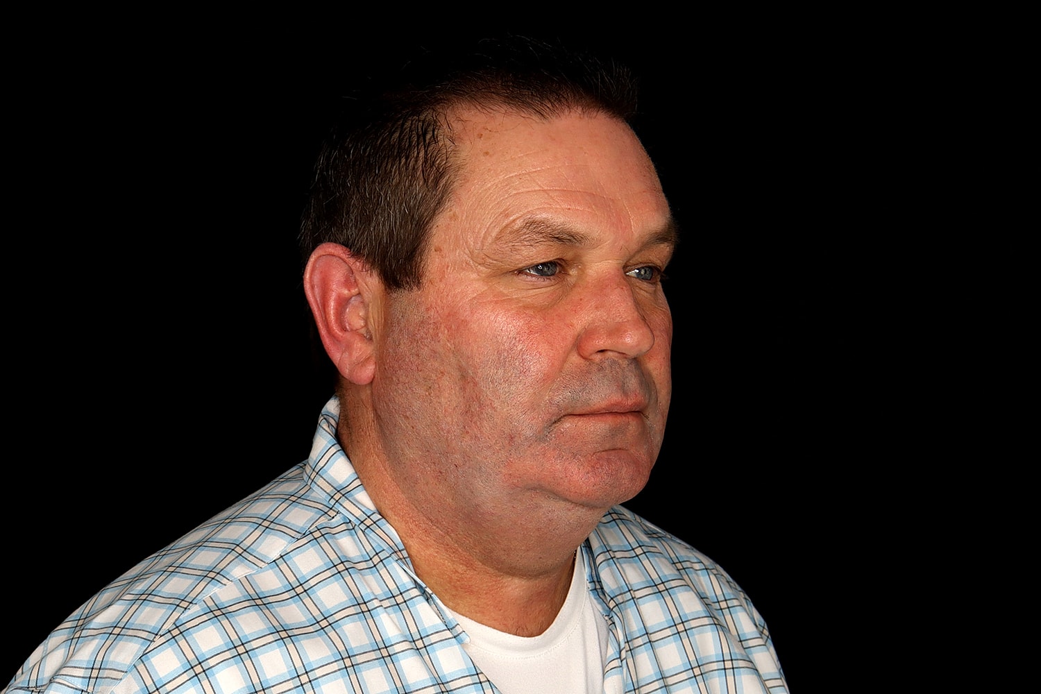 Chin Liposuction Before & After