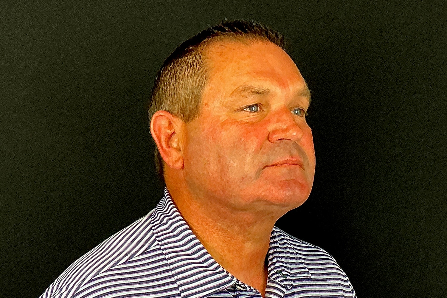 Chin Liposuction Before & After