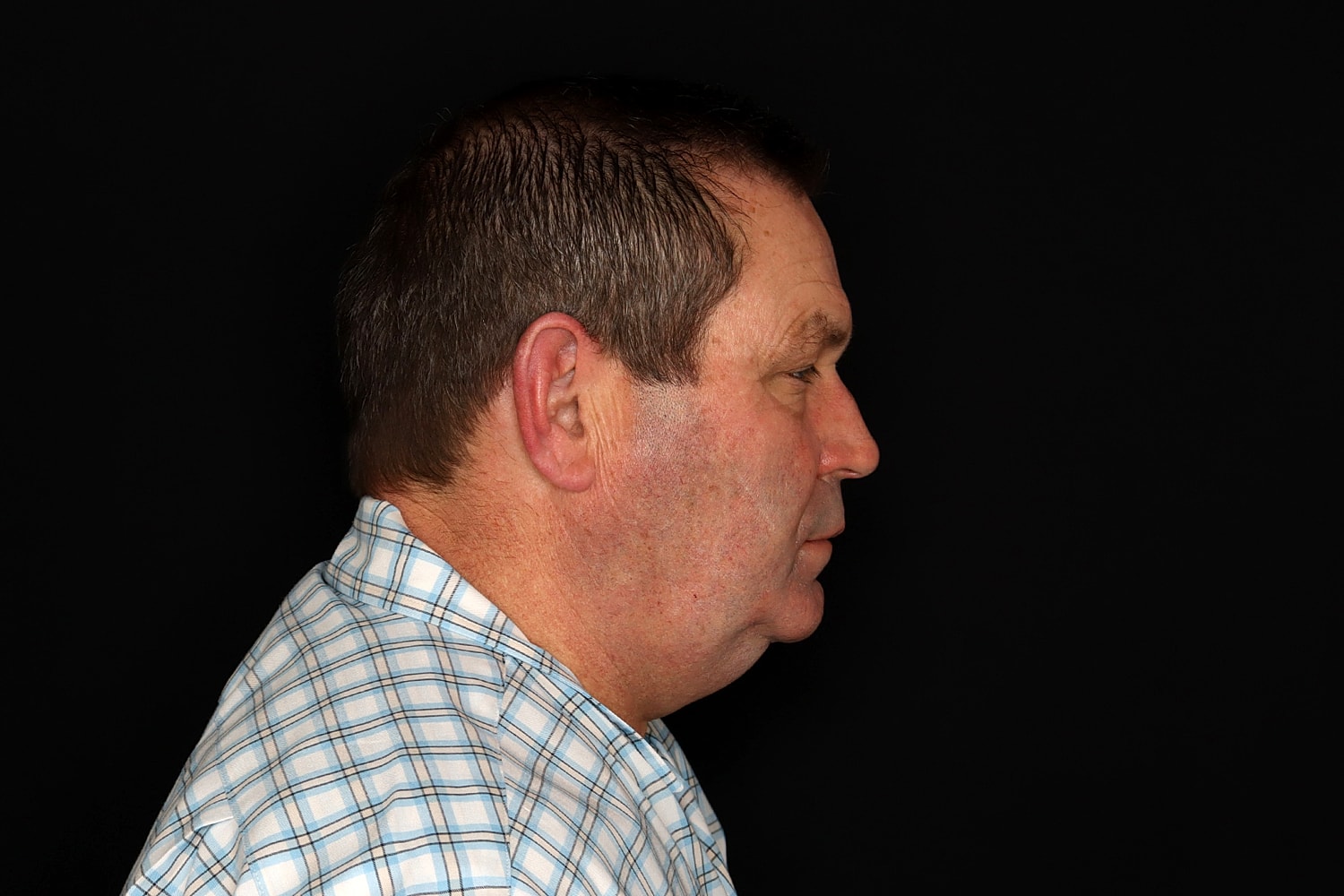 Chin Liposuction Before & After