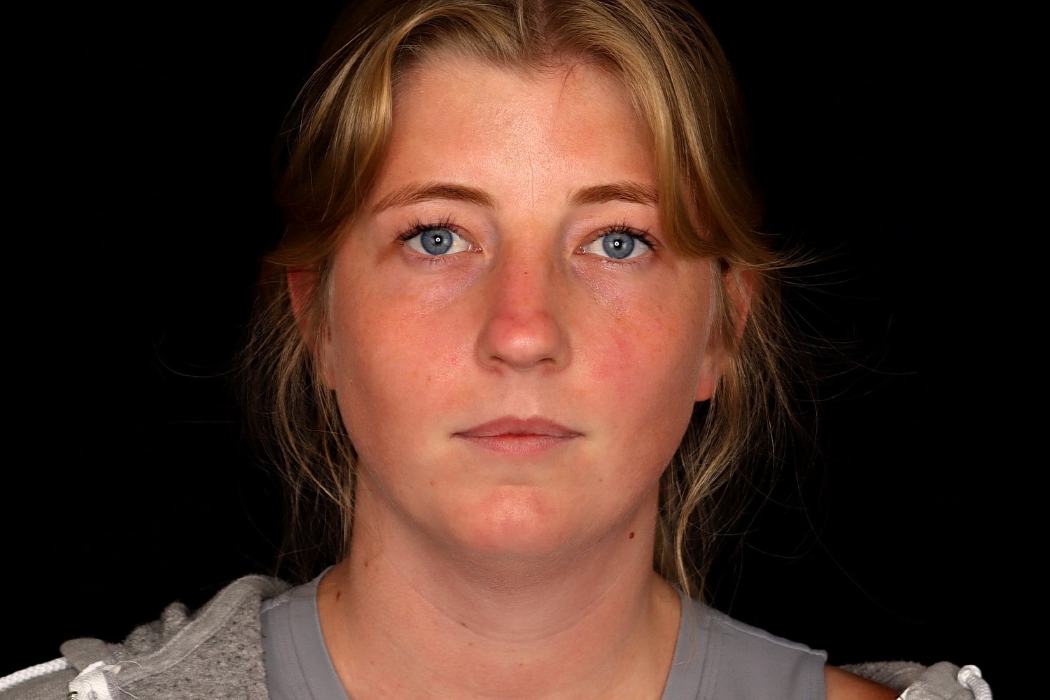 Chin Liposuction Before & After
