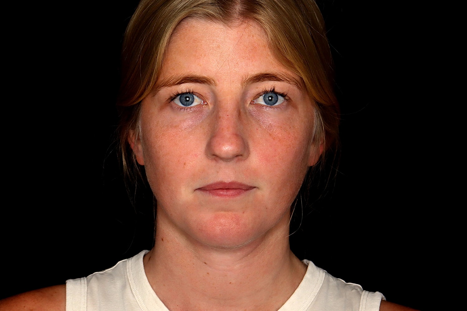 Chin Liposuction Before & After