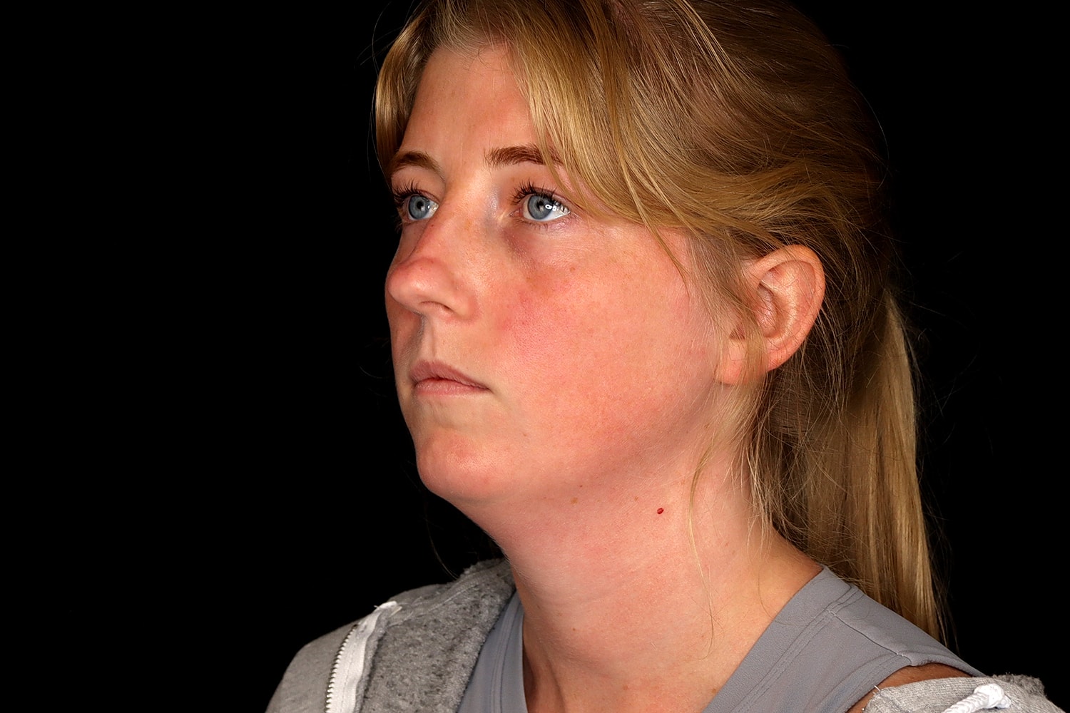 Chin Liposuction Before & After