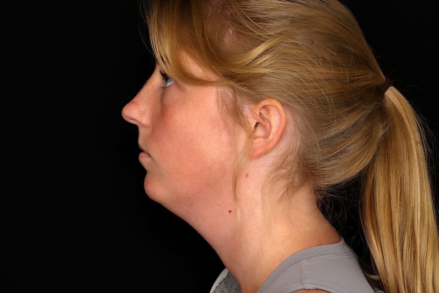Chin Liposuction Before & After