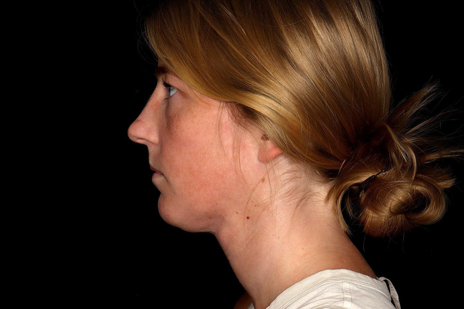 Chin Liposuction Before & After