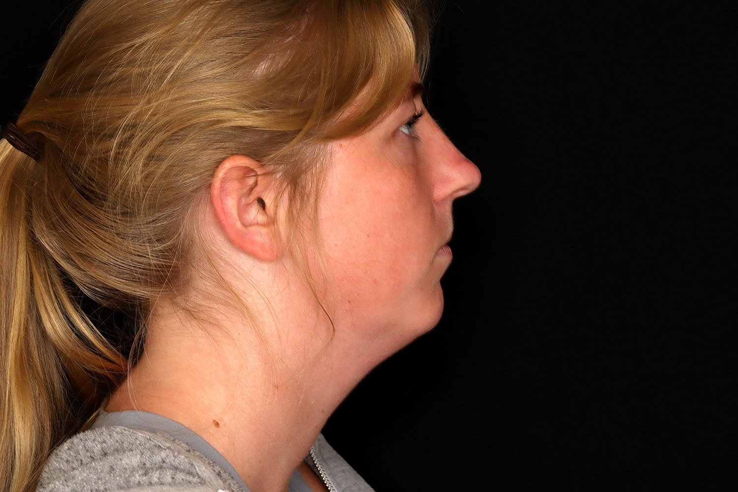 Chin Liposuction Before & After