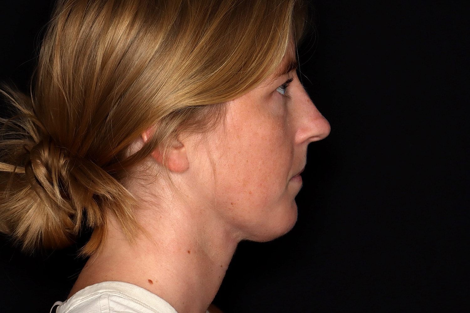 Chin Liposuction Before & After