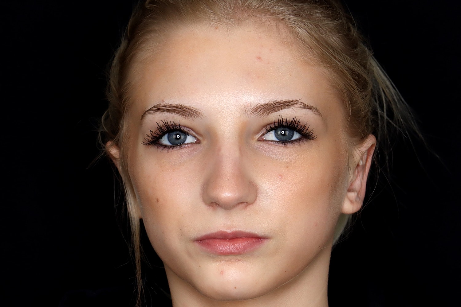 Otoplasty Before & After