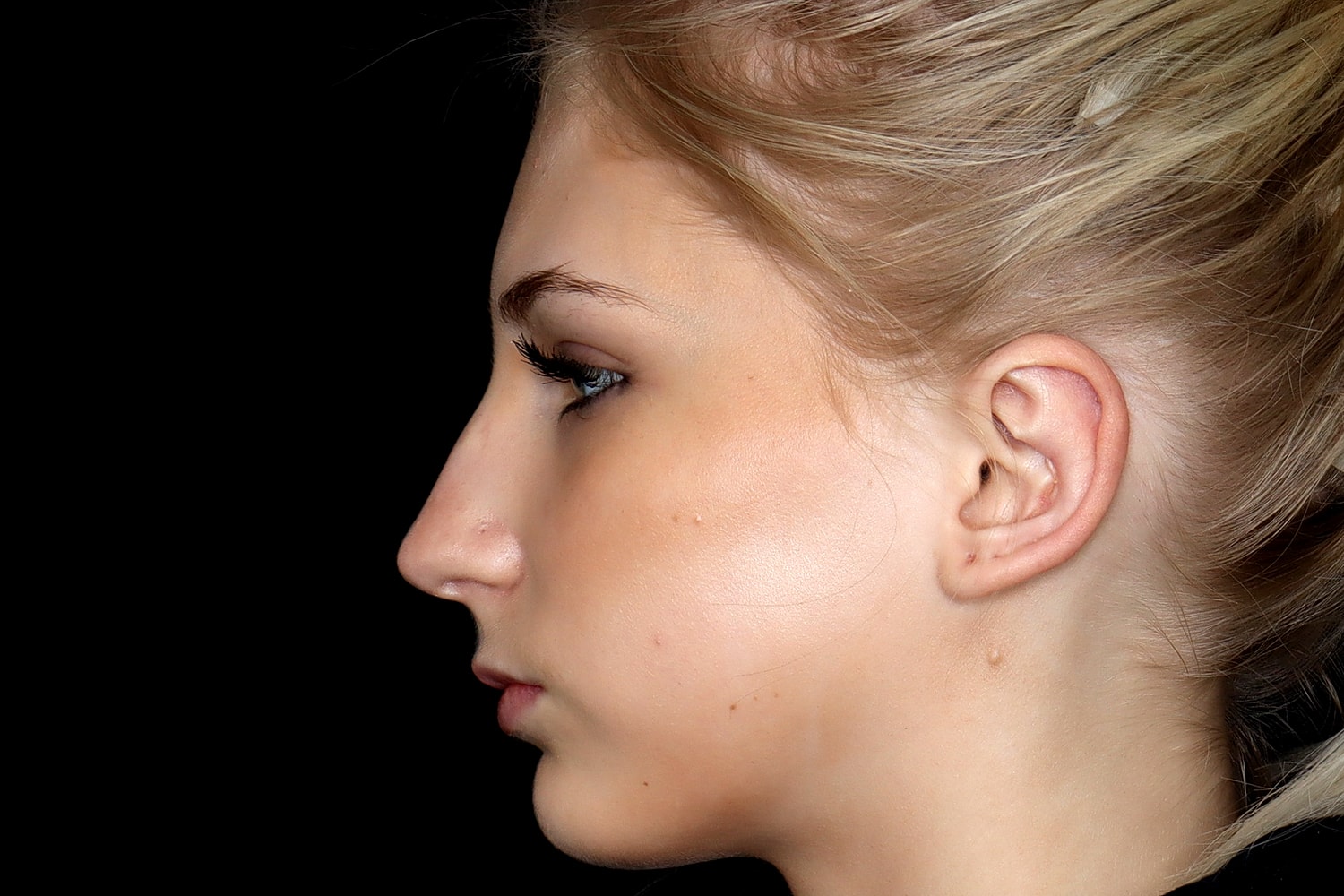Otoplasty Before & After