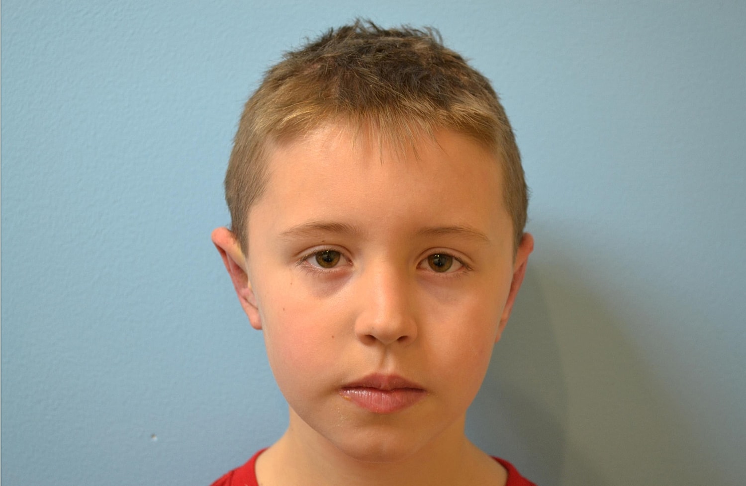Otoplasty Before & After