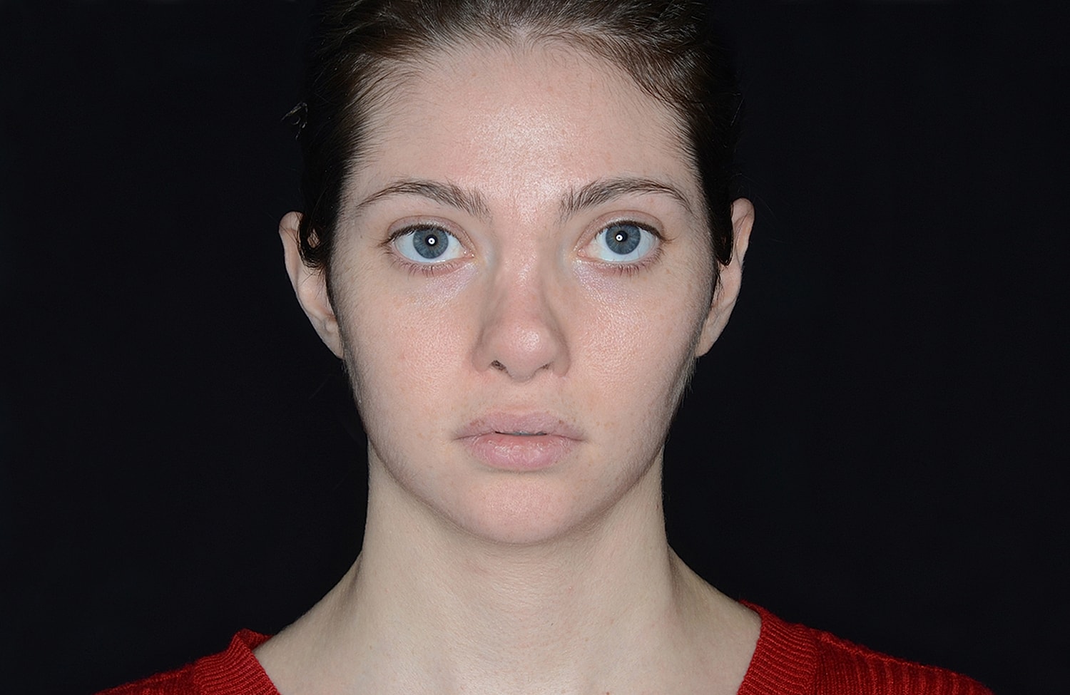 Otoplasty Before & After