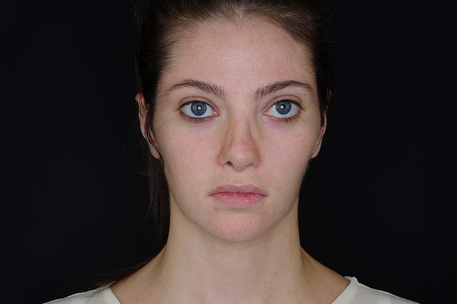 Otoplasty Before & After