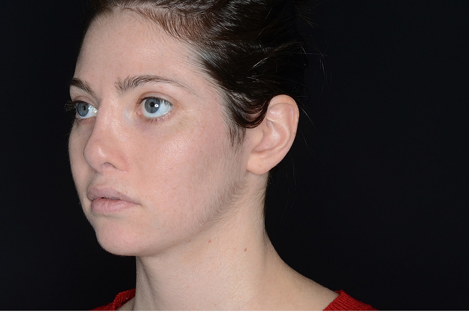 Otoplasty Before & After