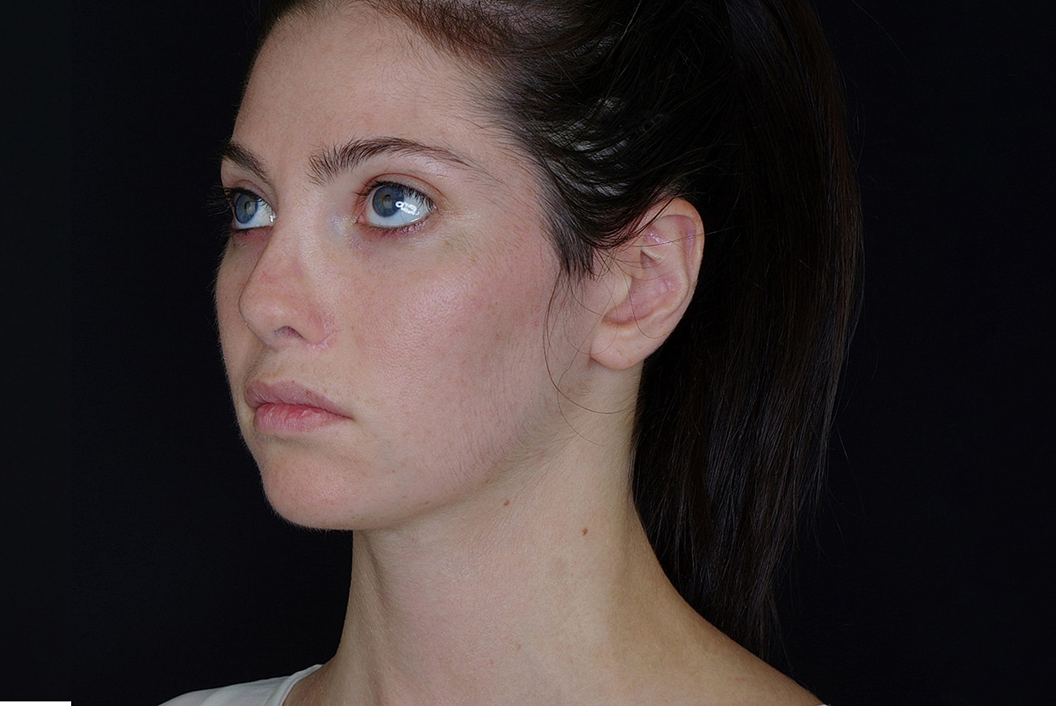 Otoplasty Before & After