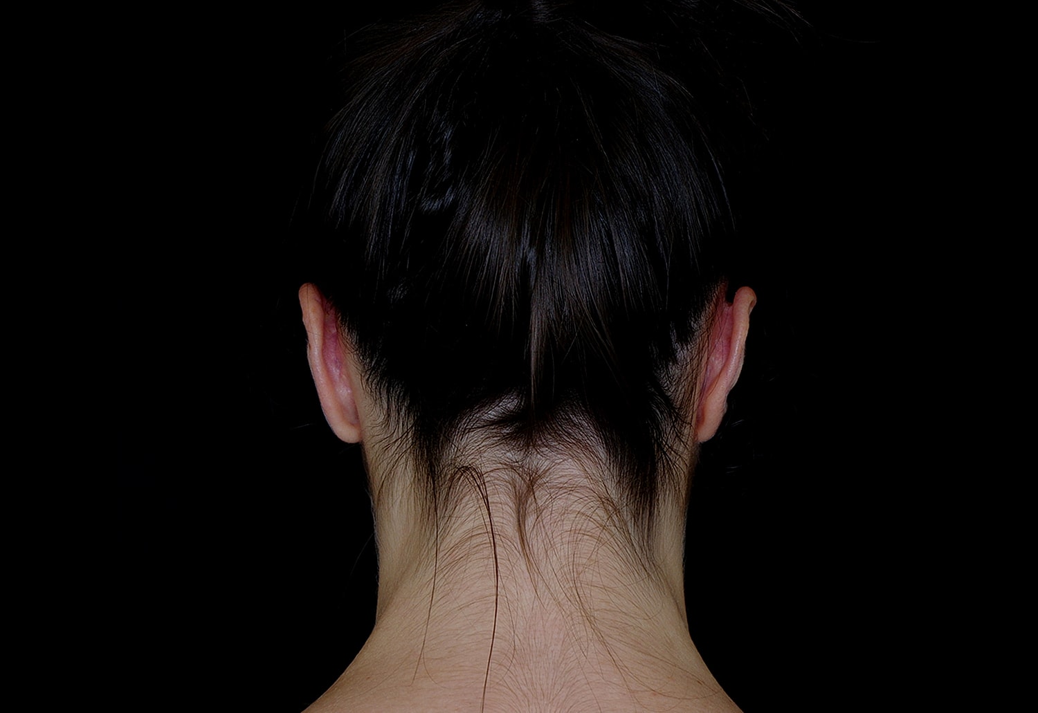 Otoplasty Before & After
