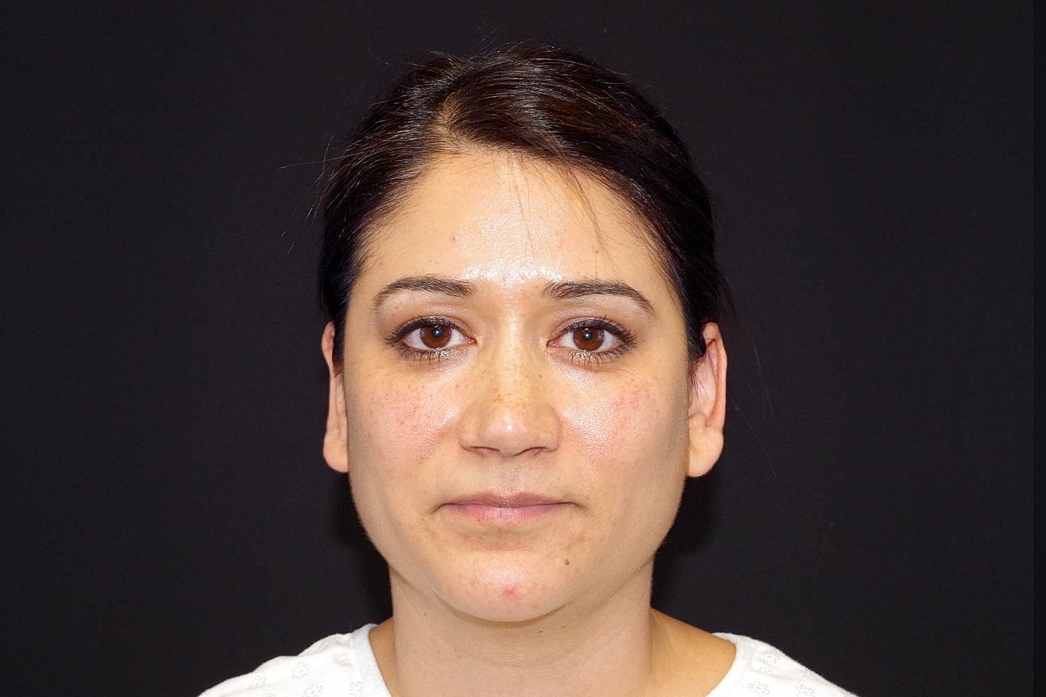 Otoplasty Before & After