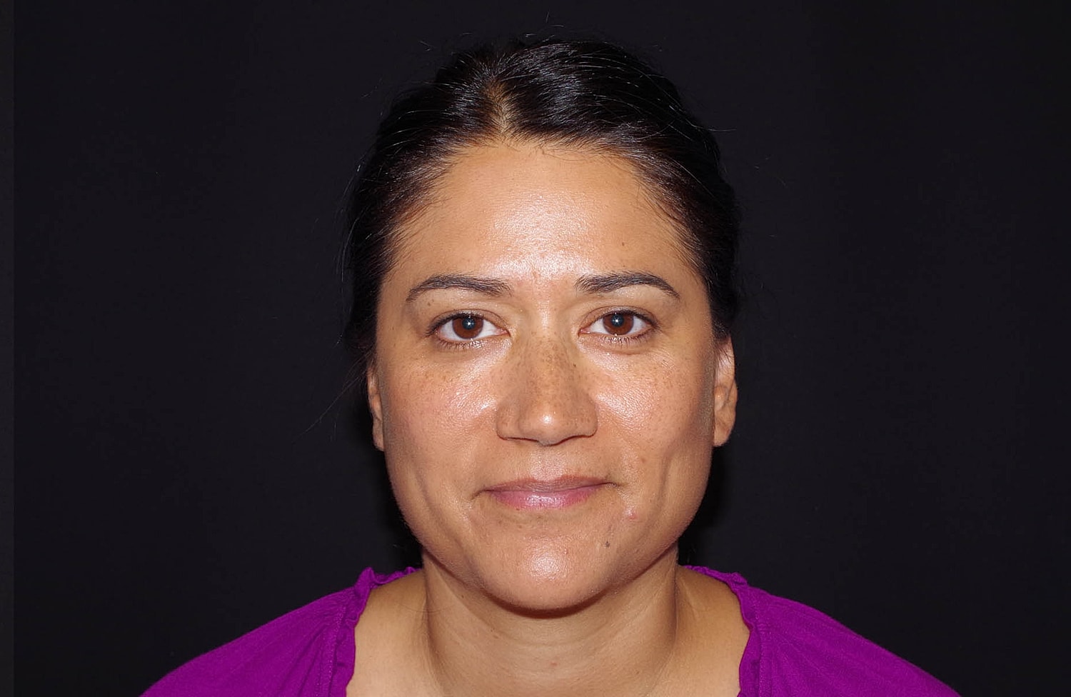 Otoplasty Before & After