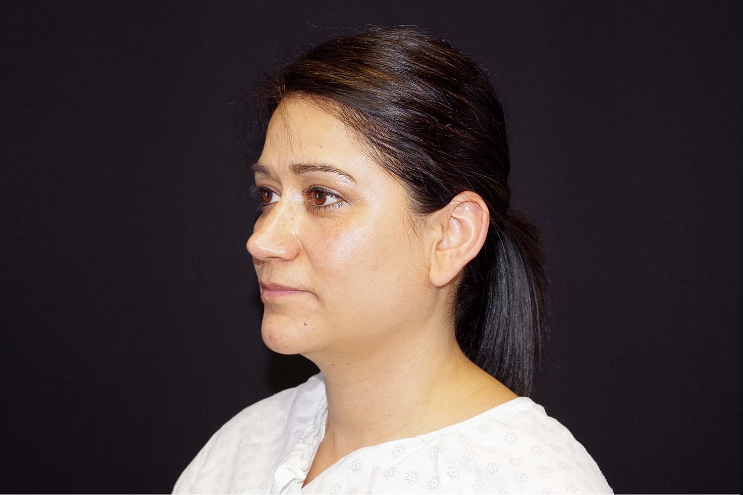 Otoplasty Before & After