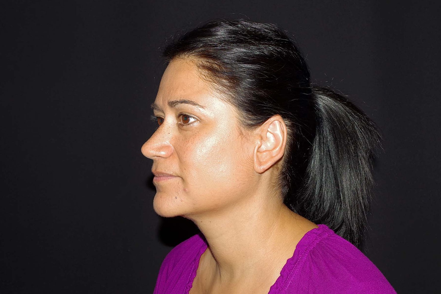Otoplasty Before & After