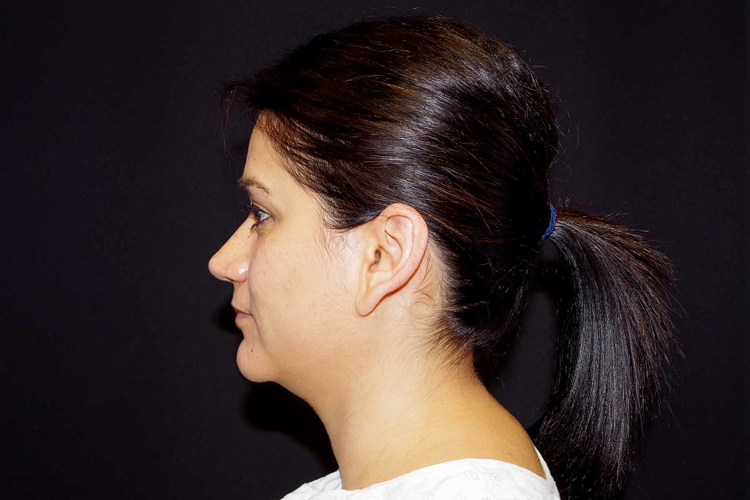 Otoplasty Before & After