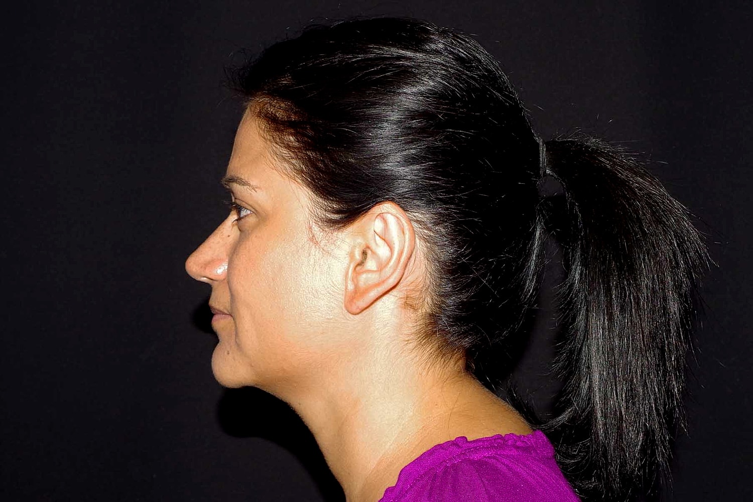Otoplasty Before & After