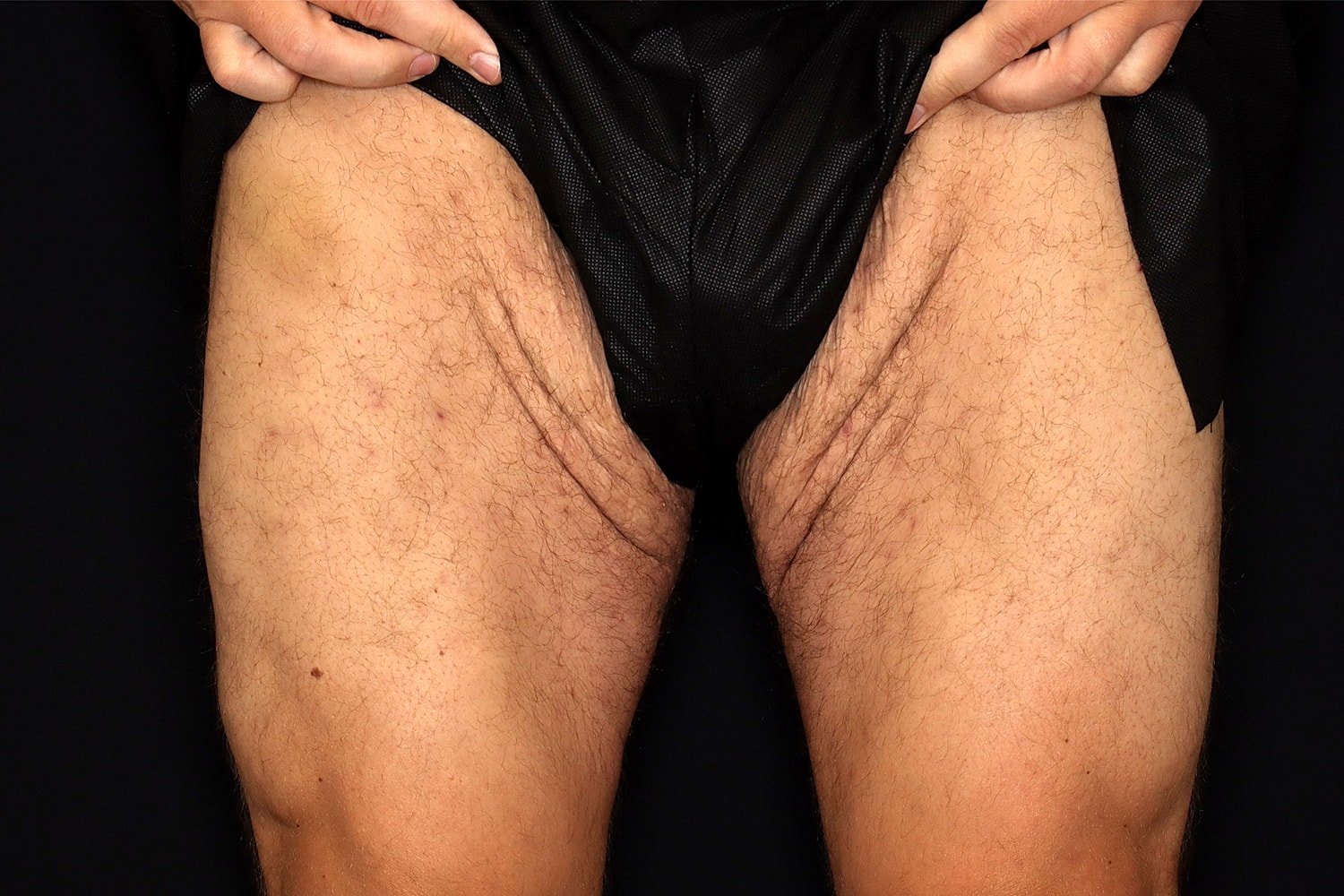 Thigh Lift Before & After