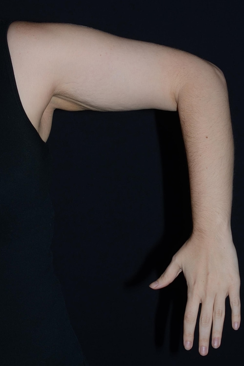 Brachioplasty | Arm Lift Before & After