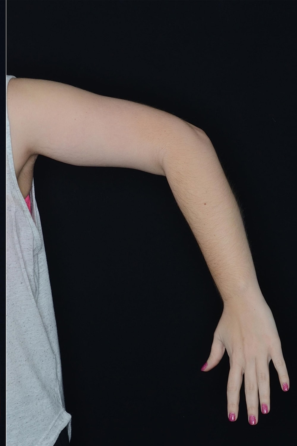 Brachioplasty | Arm Lift Before & After