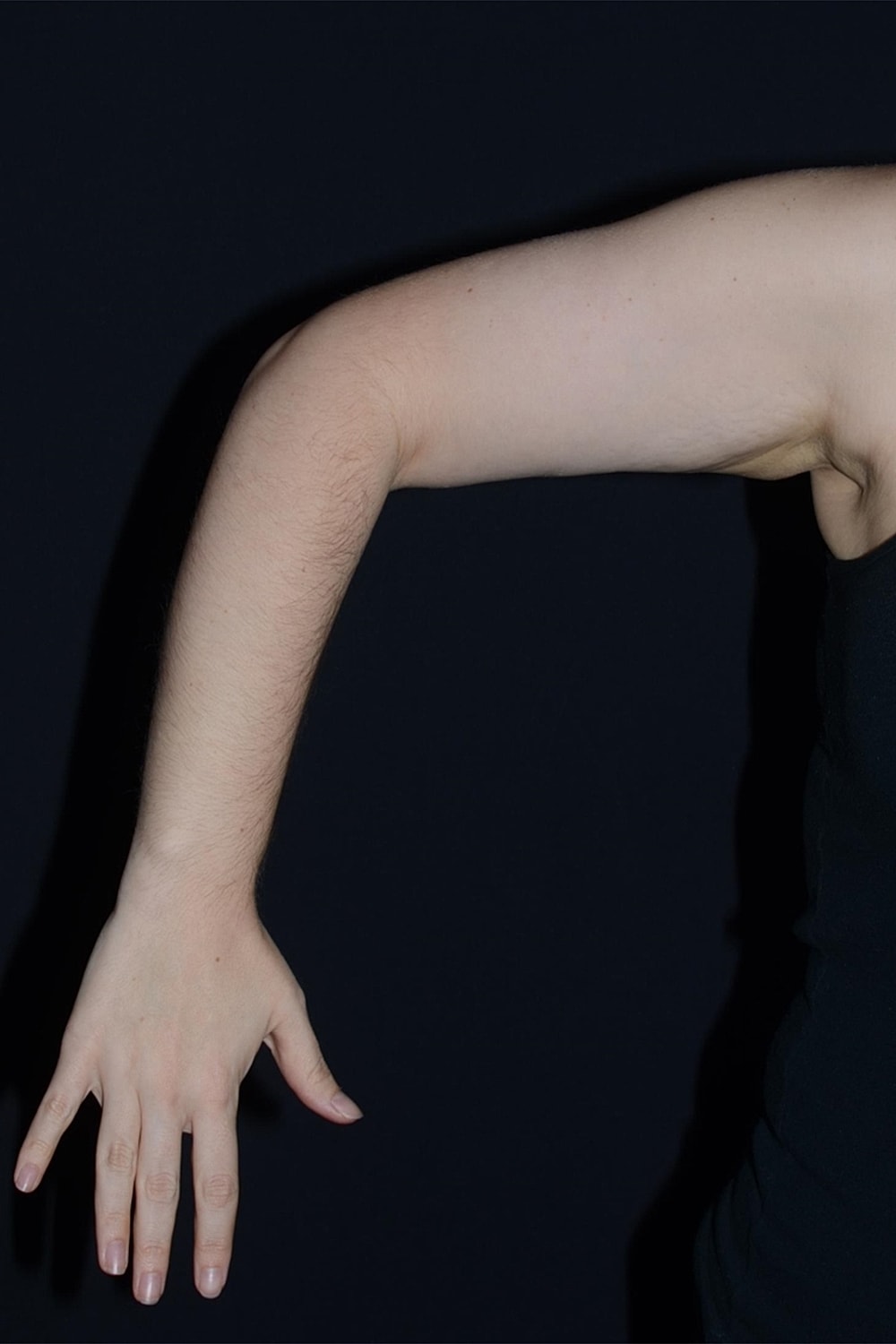 Brachioplasty | Arm Lift Before & After