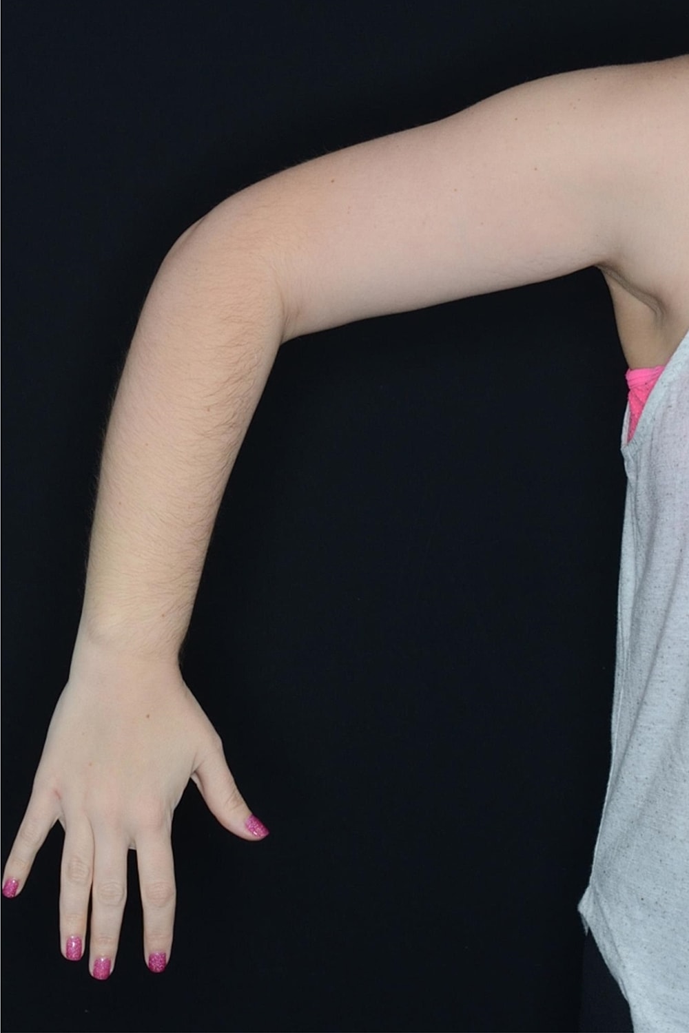 Brachioplasty | Arm Lift Before & After