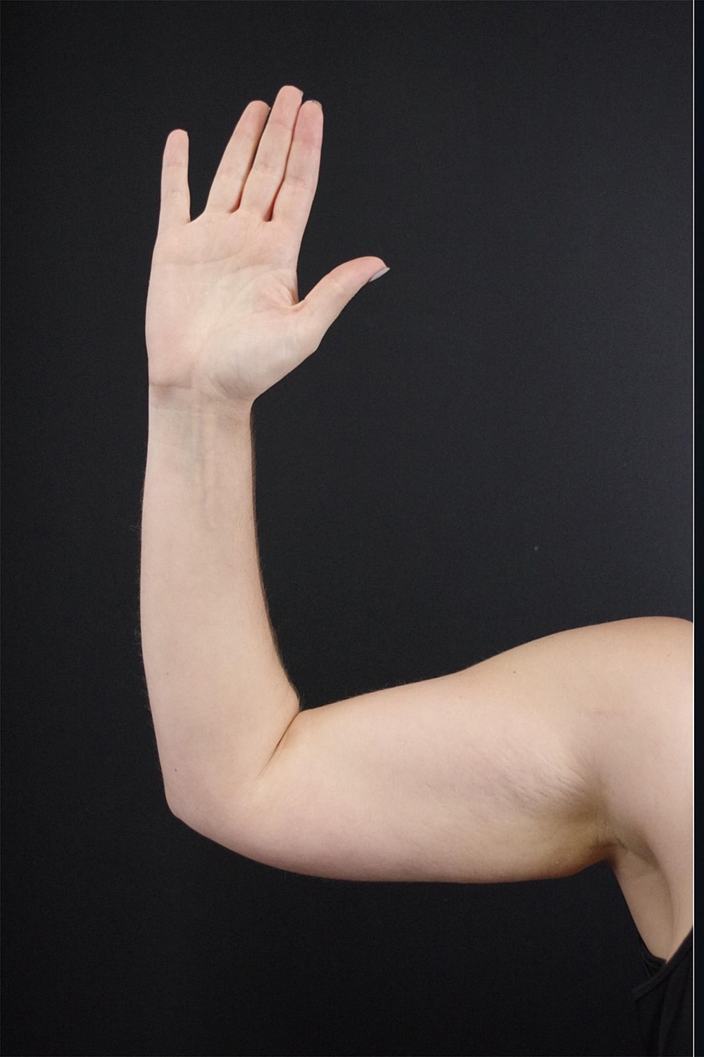 Brachioplasty | Arm Lift Before & After