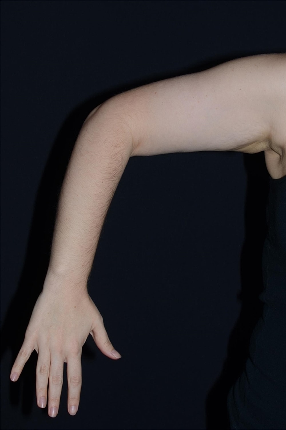 Brachioplasty | Arm Lift Before & After