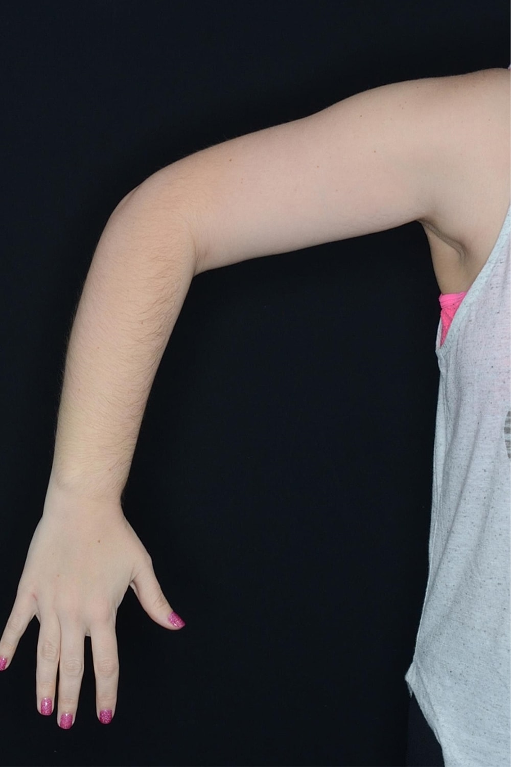 Brachioplasty | Arm Lift Before & After