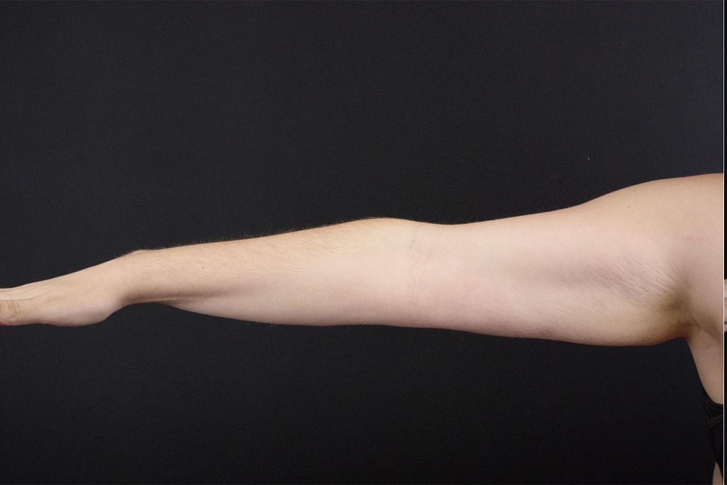 Brachioplasty | Arm Lift Before & After