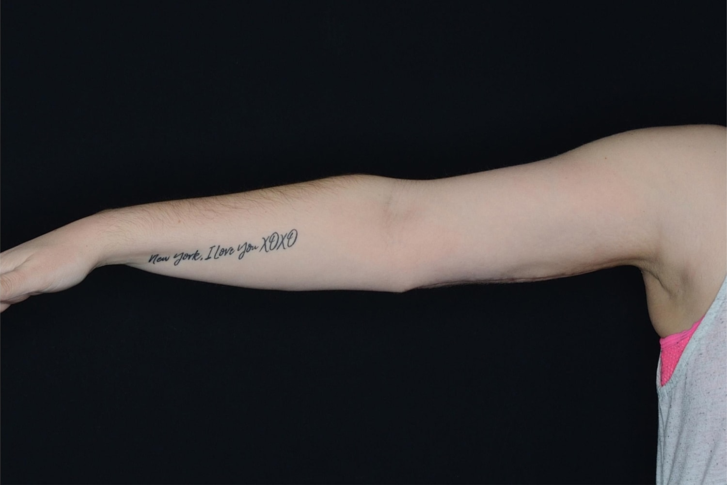 Brachioplasty | Arm Lift Before & After
