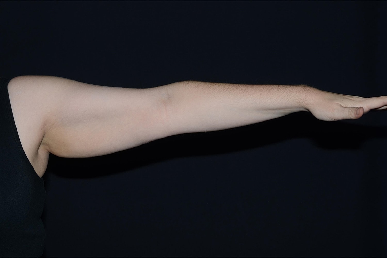 Brachioplasty | Arm Lift Before & After