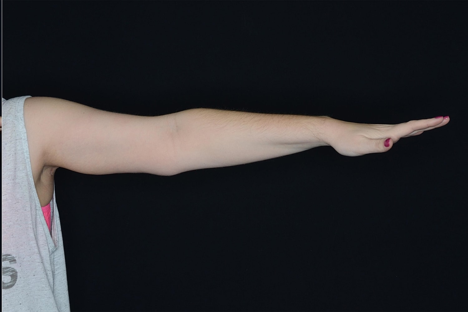 Brachioplasty | Arm Lift Before & After