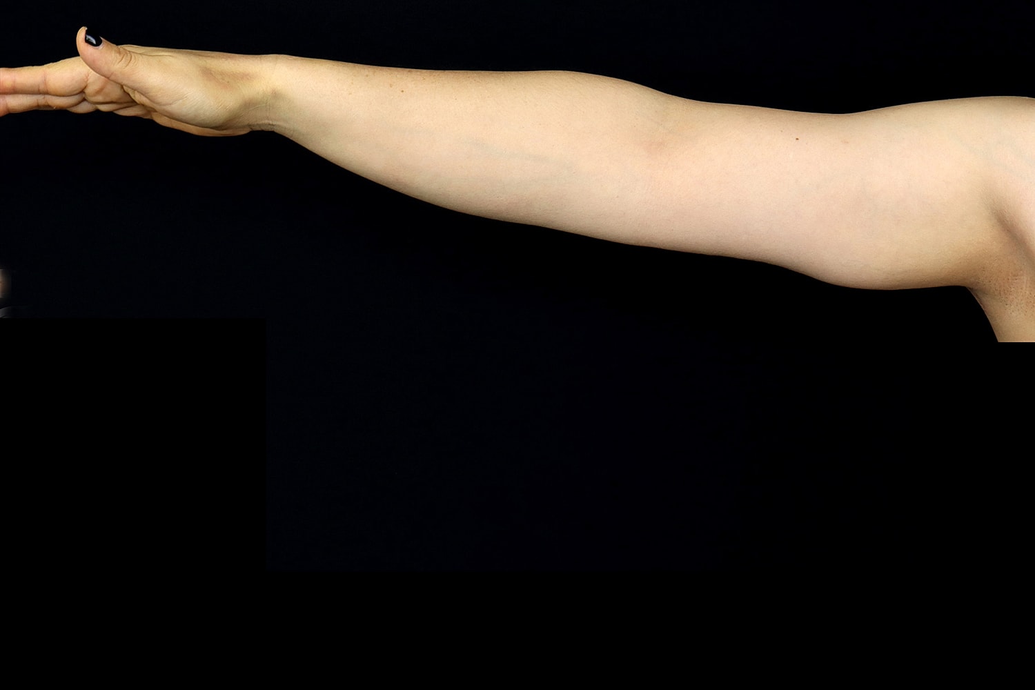 Brachioplasty | Arm Lift Before & After