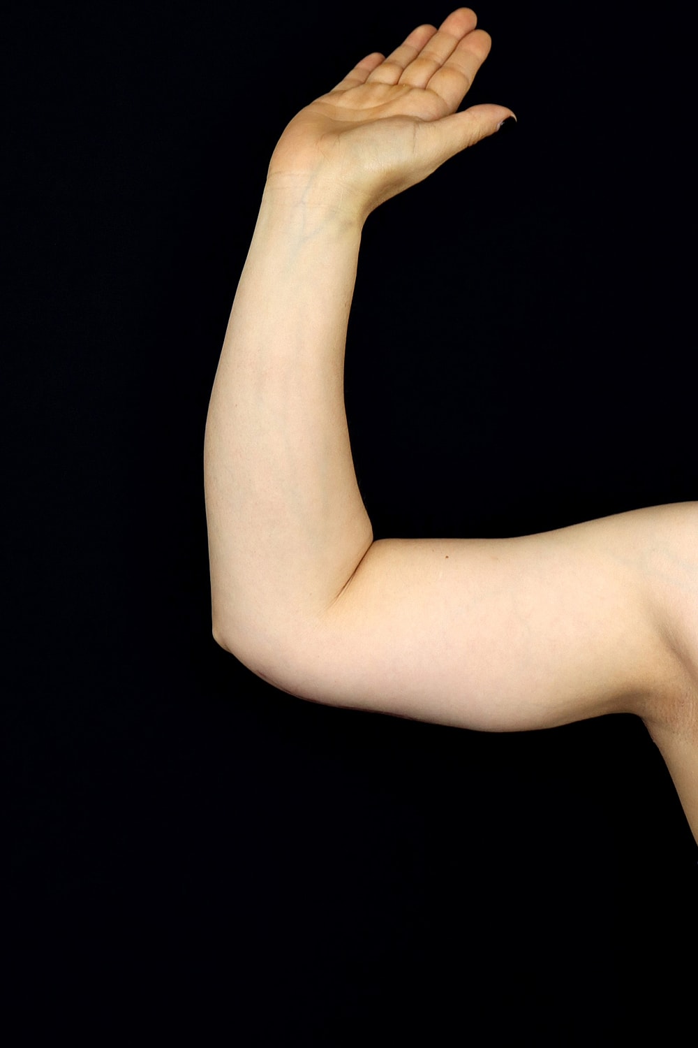 Brachioplasty | Arm Lift Before & After