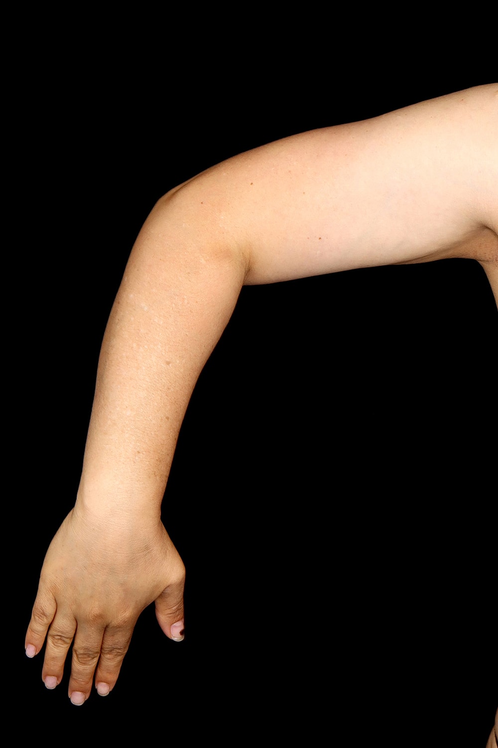 Brachioplasty | Arm Lift Before & After