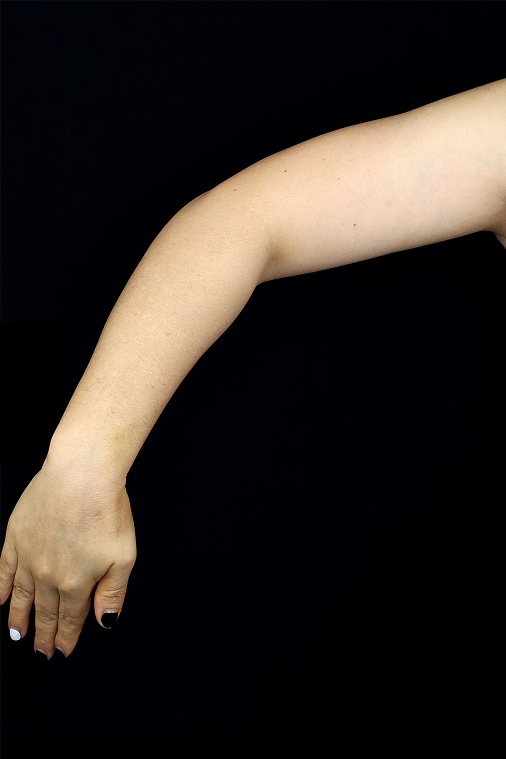 Brachioplasty | Arm Lift Before & After