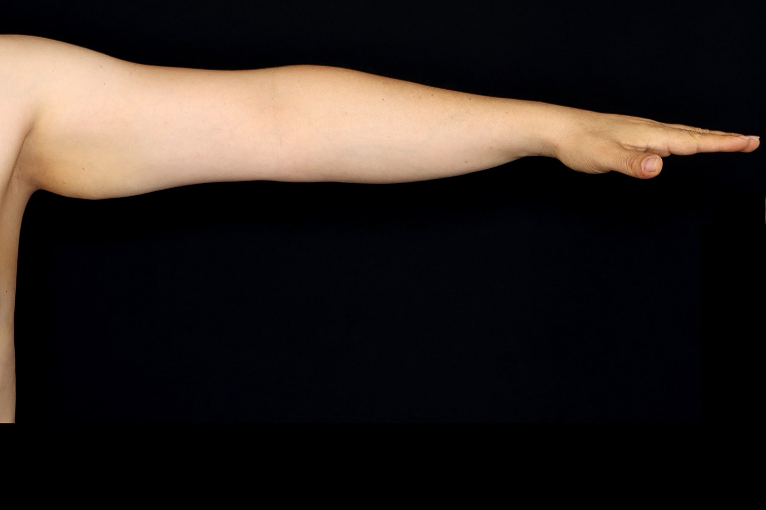 Brachioplasty | Arm Lift Before & After