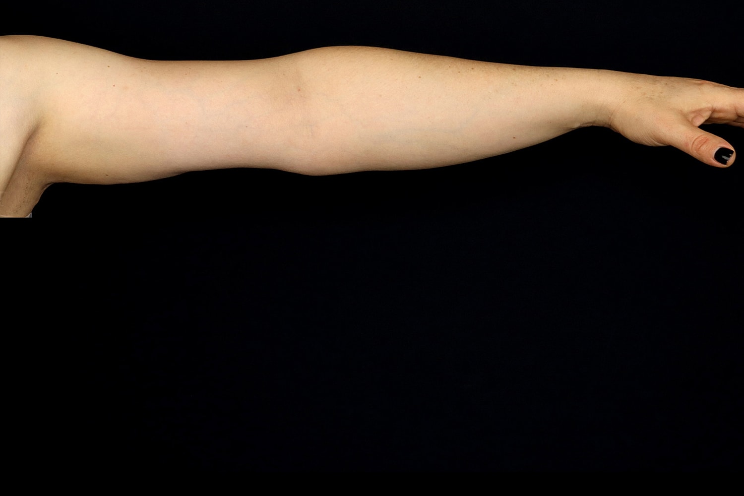Brachioplasty | Arm Lift Before & After